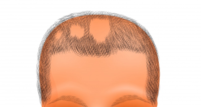 A Patient’s Journey of getting Hair Transplant in Pune