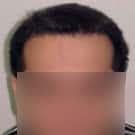 Hair Transplant Patient Testimonial Delhi