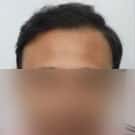 Hair Transplant Patient Testimonial Delhi