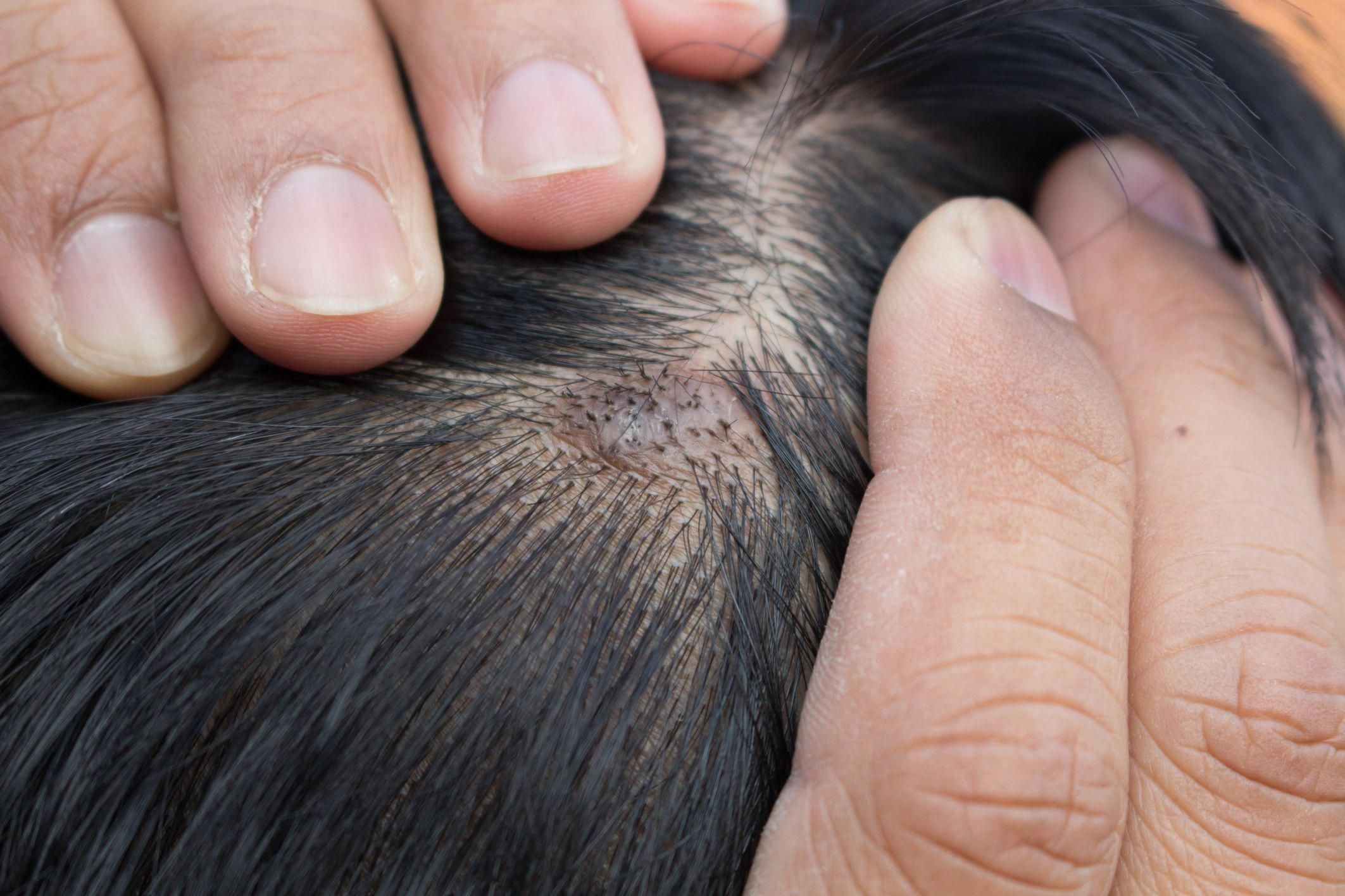 Hair loss causes Scalp Diseases