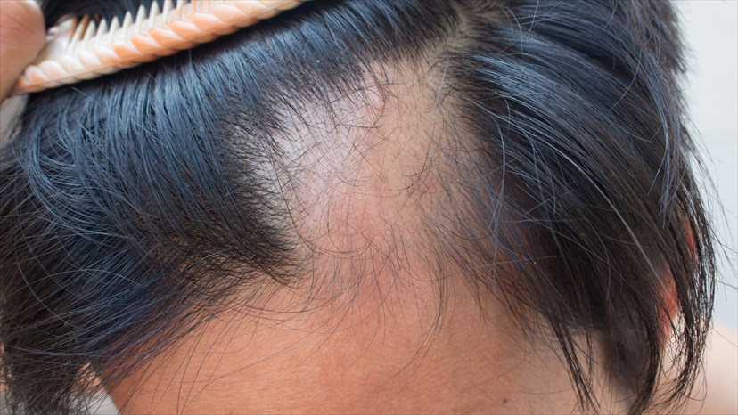 Alopecia areata Hair loss causes