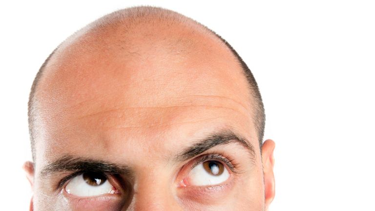 Is Hair transplant is best solution for baldness