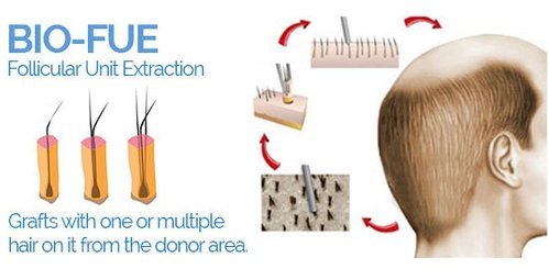 Bio Fue Hair Transplant