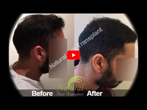 First Choice Hair Transplant & Cosmetics