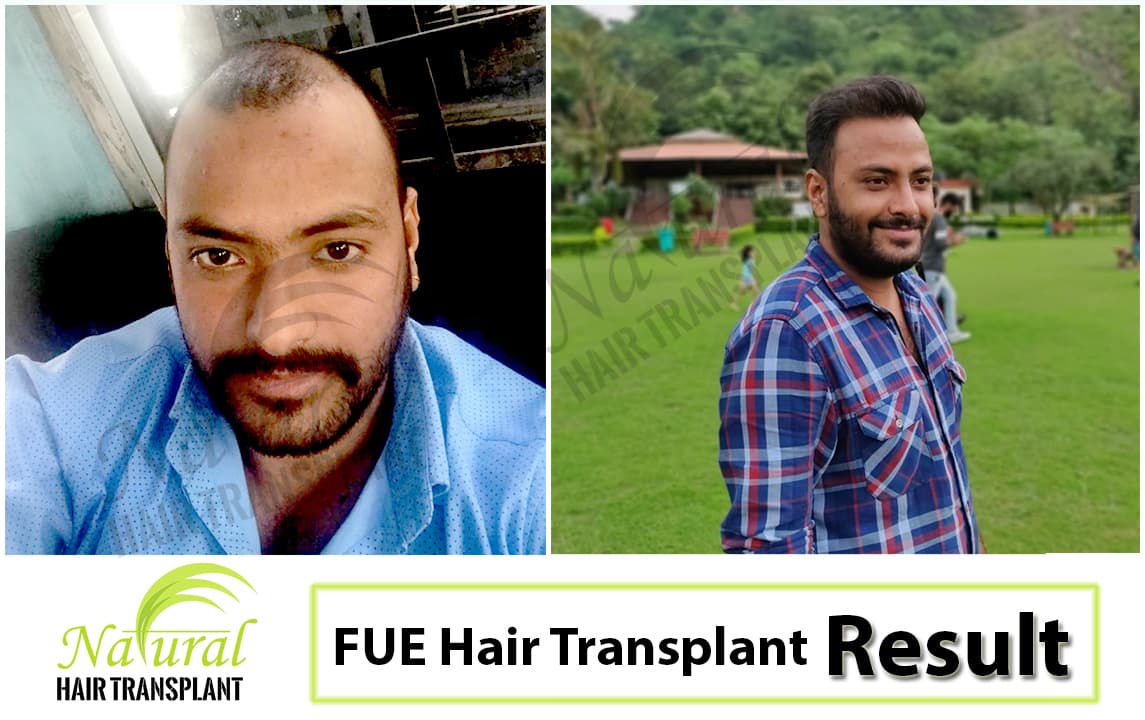 Best Hair Transplant Clinic in Agra - Affordable Hair Treatment | NHT