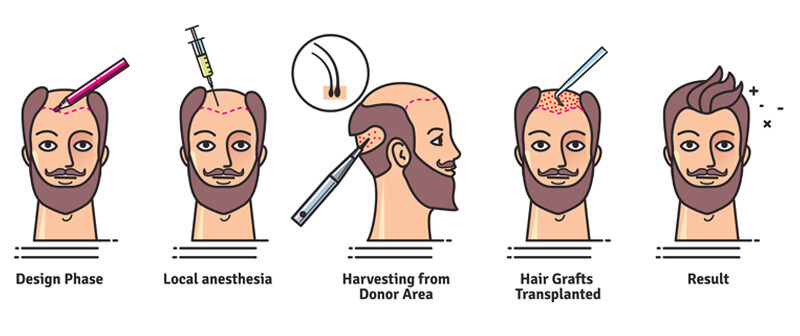  hair transplant procedure