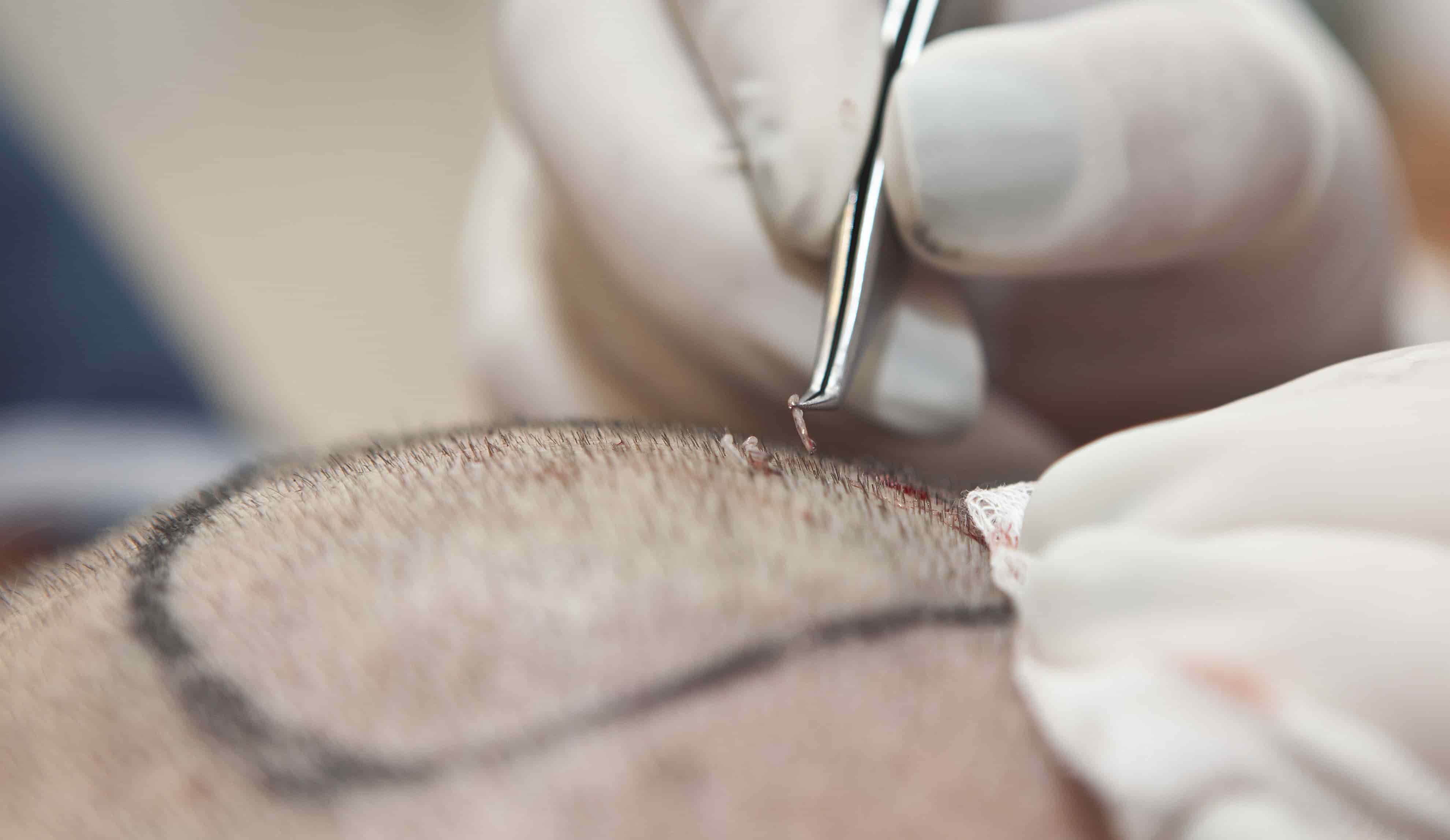 Hair Transplant in Delhi