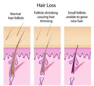 Cauese of Hair Loss