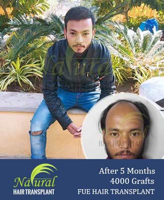 Hair Transplant Results of 4000 Grafts