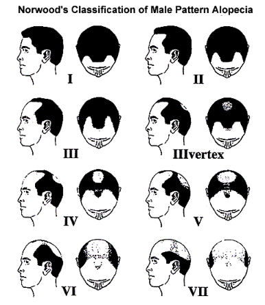 Male Pattern Alopecia