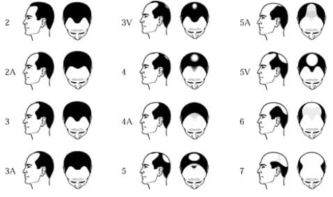 Male Pattern Baldness