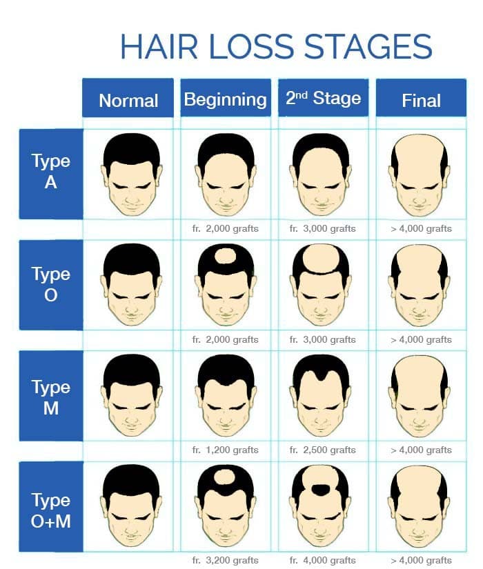 Male Pattern Alopecia
