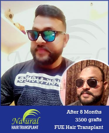 Hair Transplant Results of 3500 Grafts