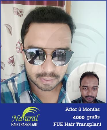Hair Transplant Results of 4000 Grafts
