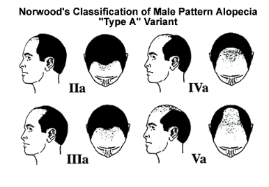 Male Pattern Alopecia Type A