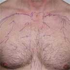 Body Hair Transplant