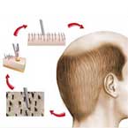 Fue Hair Transplant