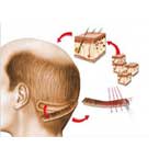 Fut Hair Transplant