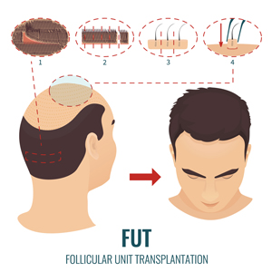 Best hair transplant in Ranchi | know hair transplant cost & clinic