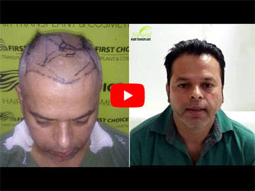 Hair Transplant Procedure video