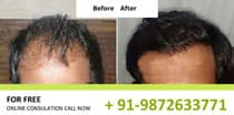 Hair Transplant Results in Delhi
