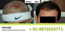 Hair Transplant Cost in Pune